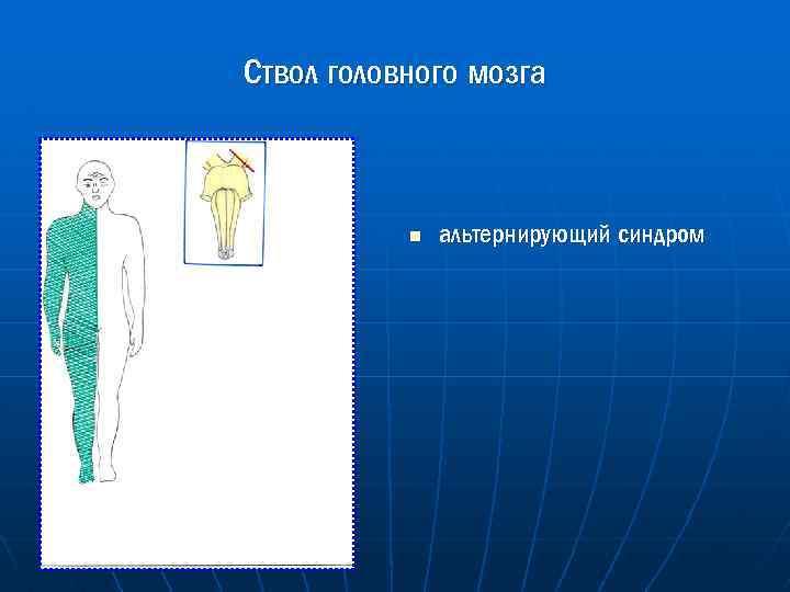 Ствол головного мозга n альтернирующий синдром 