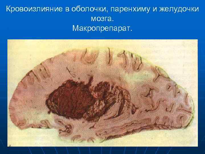 Кровоизлияние в оболочки, паренхиму и желудочки мозга. Макропрепарат. 