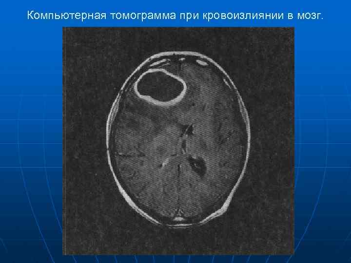 Компьютерная томограмма при кровоизлиянии в мозг. 