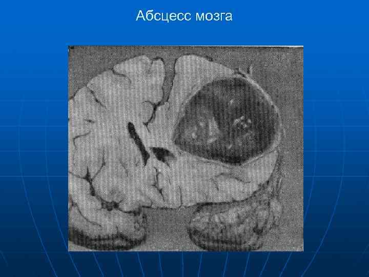 Абсцесс мозга 