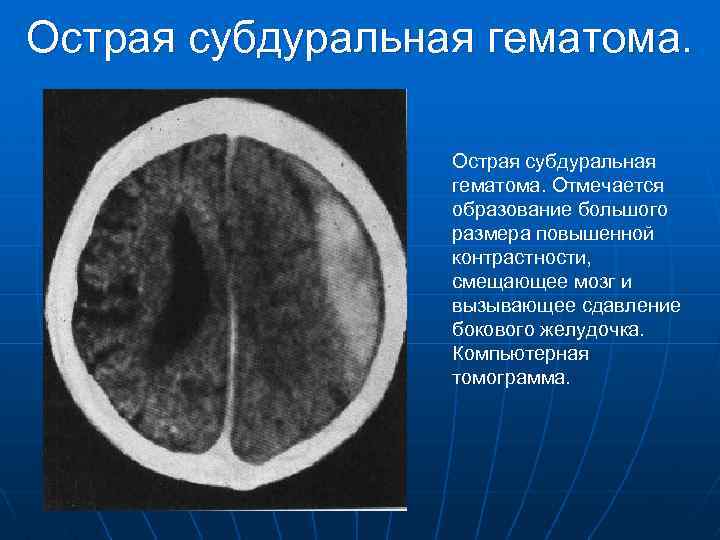 Острая субдуральная гематома. Отмечается образование большого размера повышенной контрастности, смещающее мозг и вызывающее сдавление
