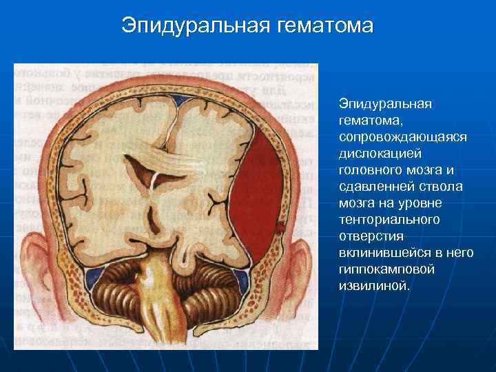 Дислокация головного мозга