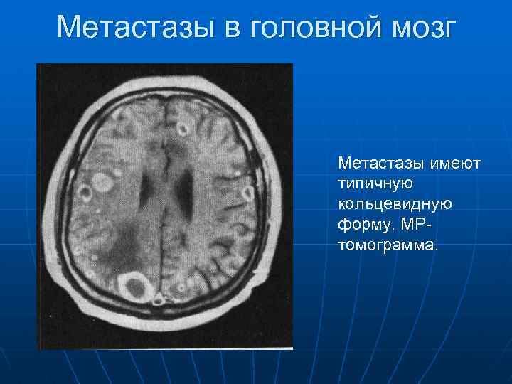 Метастазы в головной мозг Метастазы имеют типичную кольцевидную форму. МРтомограмма. 