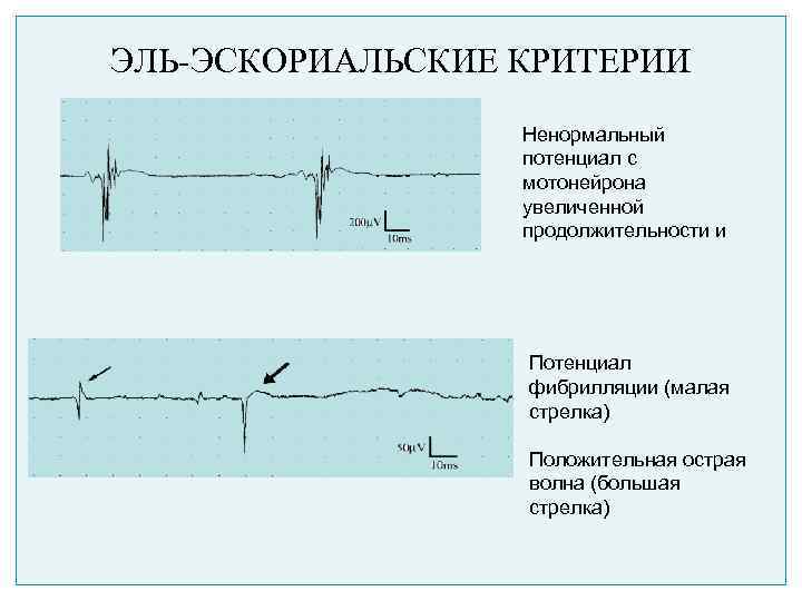 ЭЛЬ-ЭСКОРИАЛЬСКИЕ КРИТЕРИИ Ненормальный потенциал с мотонейрона увеличенной продолжительности и Потенциал фибрилляции (малая стрелка) Положительная