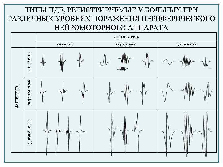 ТИПЫ ПДЕ, РЕГИСТРИРУЕМЫЕ У БОЛЬНЫХ ПРИ РАЗЛИЧНЫХ УРОВНЯХ ПОРАЖЕНИЯ ПЕРИФЕРИЧЕСКОГО НЕЙРОМОТОРНОГО АППАРАТА длительность нормальна