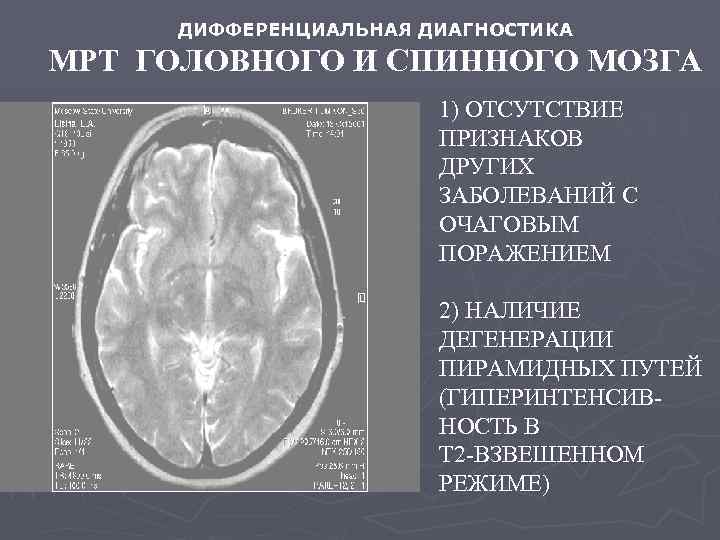 Дегенерация головного. Болезнь двигательного неврона мрт. Дифференциальная диагностика очагового поражения спинного мозга. Мрт головного мозга с поражением. Патология спинного мозга на мрт.