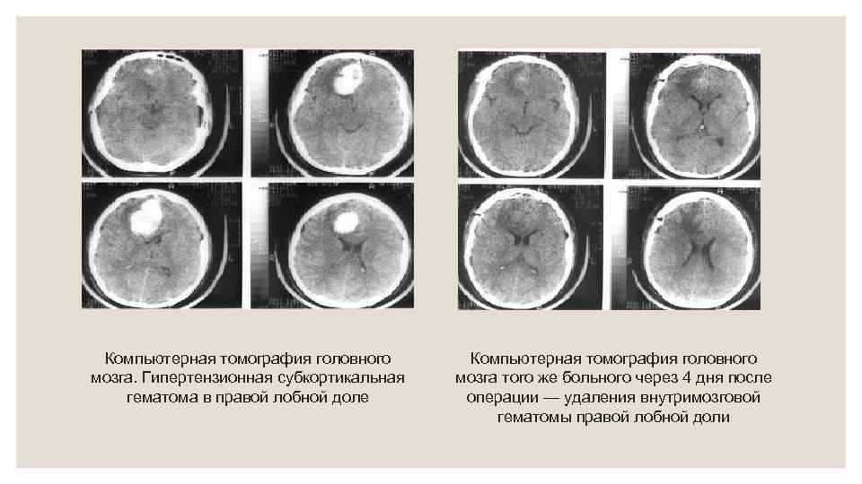 Компьютерная томография головного мозга. Гипертензионная субкортикальная гематома в правой лобной доле Компьютерная томография головного