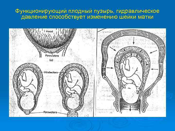 Функционирующий плодный пузырь, гидравлическое давление способствует изменению шейки матки 