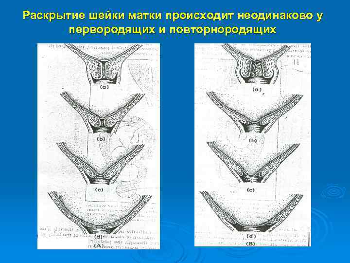 Раскрытие шейки матки происходит неодинаково у первородящих и повторнородящих 