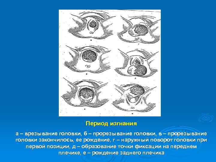 Период изгнания а – врезывание головки, б – прорезывание головки, в – прорезывание головки