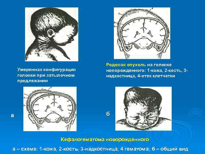 Умеренная конфигурация головки при затылочном предлежании а Родовая опухоль на головке новорожденного: 1 кожа,