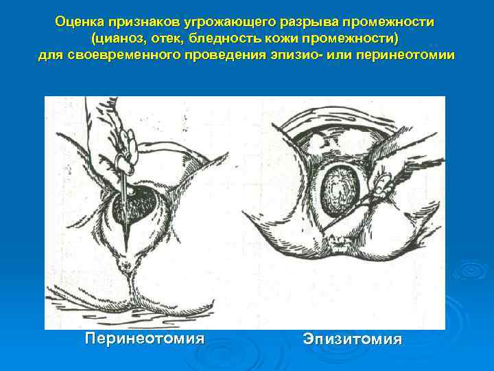 Оценка признаков угрожающего разрыва промежности (цианоз, отек, бледность кожи промежности) для своевременного проведения эпизио