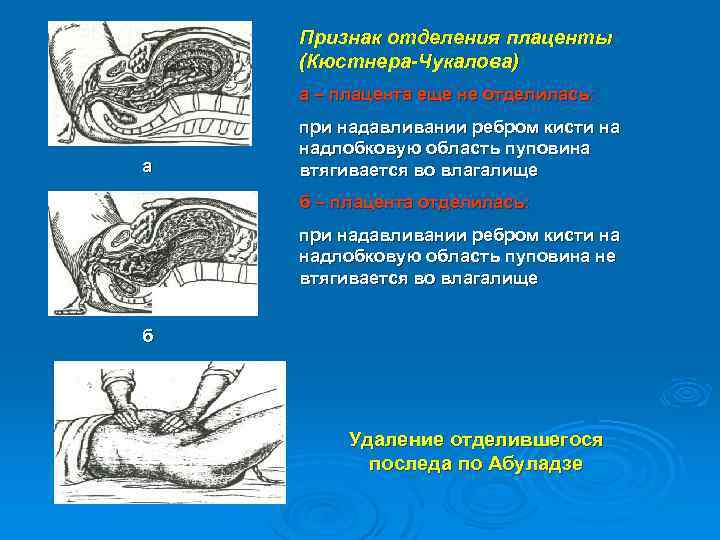 Признак отделения плаценты (Кюстнера-Чукалова) а – плацента еще не отделилась: а при надавливании ребром