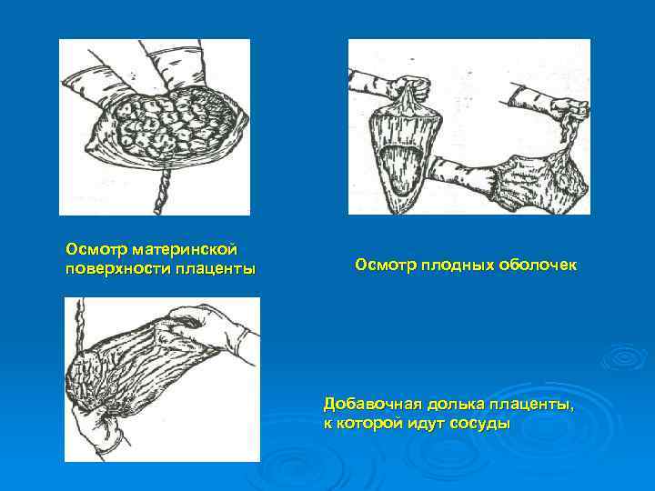 Осмотр материнской поверхности плаценты Осмотр плодных оболочек Добавочная долька плаценты, к которой идут сосуды