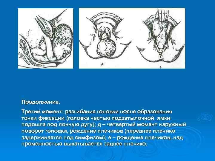 Продолжение. Третий момент: разгибание головки после образования точки фиксации (головка частью подзатылочной ямки подошла