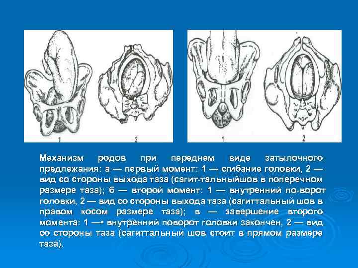 Механизм родов при переднем виде затылочного предлежания: а — первый момент: 1 — сгибание