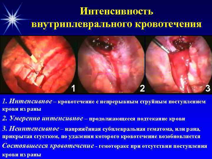 Интенсивность внутриплеврального кровотечения 1 2 3 1. Интенсивное – кровотечение с непрерывным струйным поступлением