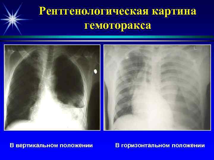 Рентгенологическая картина гемоторакса В вертикальном положении В горизонтальном положении 