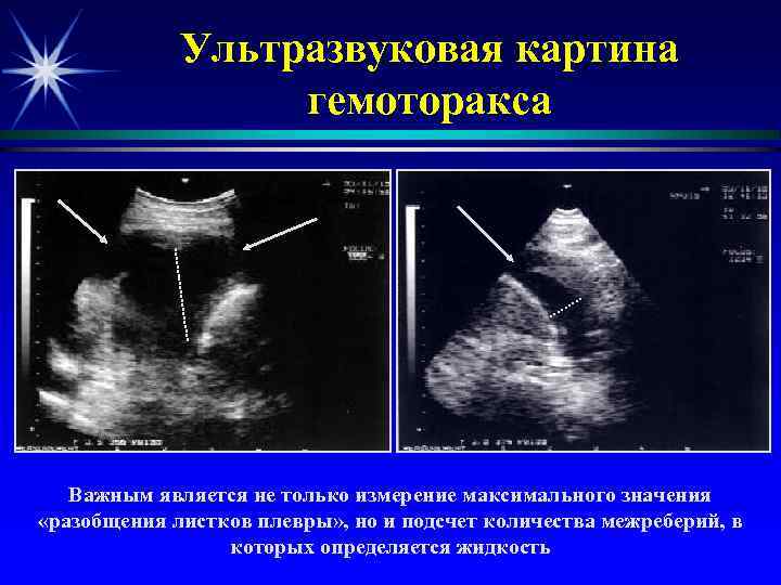 Ультразвуковая картина гемоторакса Важным является не только измерение максимального значения «разобщения листков плевры» ,