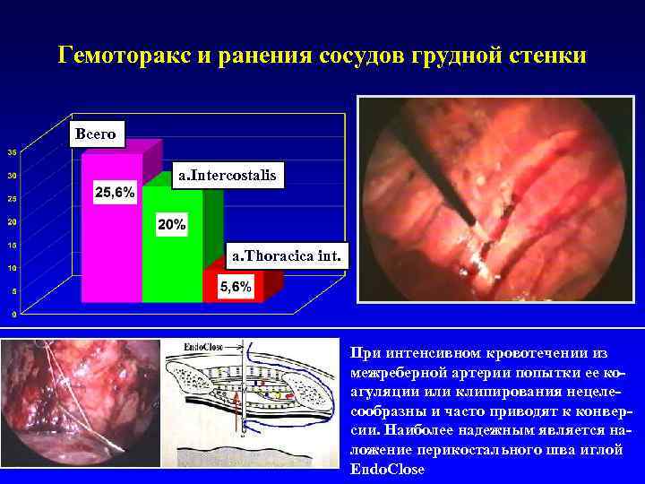 Гемоторакс и ранения сосудов грудной стенки Всего a. Intercostalis a. Thoracica int. При интенсивном