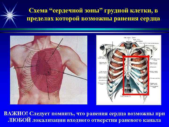 Схема “сердечной зоны” грудной клетки, в пределах которой возможны ранения сердца ВАЖНО! Следует помнить,