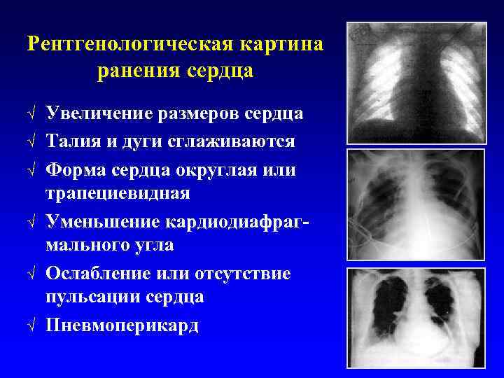 Рентгенологическая картина ранения сердца √ √ √ Увеличение размеров сердца Талия и дуги сглаживаются