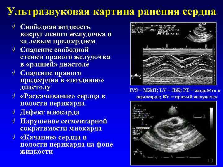 Ультразвуковая картина ранения сердца √ √ √ √ Свободная жидкость вокруг левого желудочка и