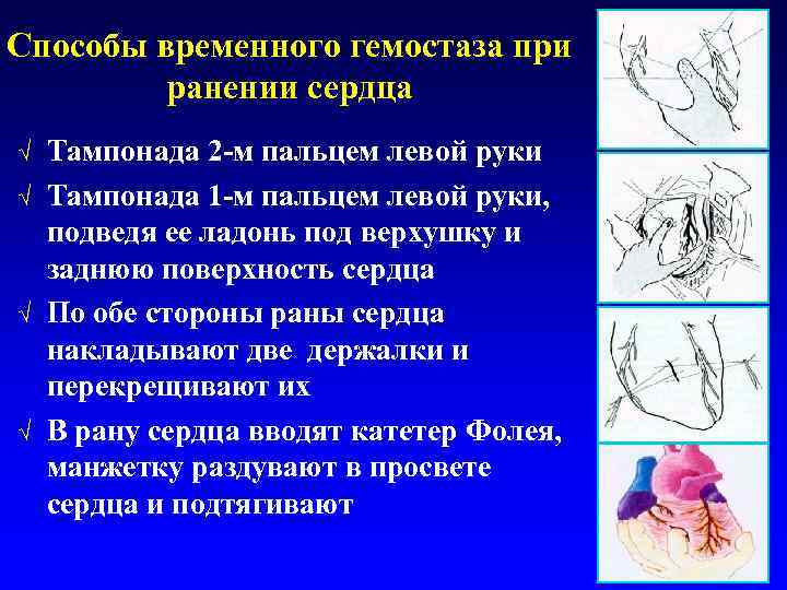 Способы временного гемостаза при ранении сердца √ √ Тампонада 2 -м пальцем левой руки