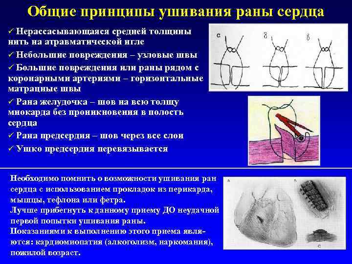 Общие принципы ушивания раны сердца Нерассасывающаяся средней толщины нить на атравматической игле ü Небольшие