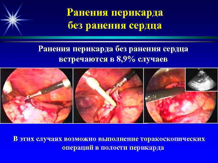 Ранения перикарда без ранения сердца встречаются в 8, 9% случаев В этих случаях возможно