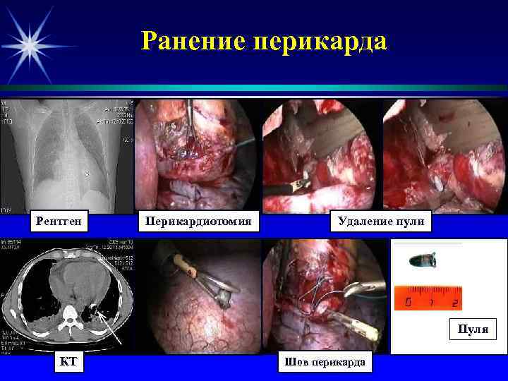 Ранение перикарда Рентген Перикардиотомия Удаление пули Пуля КТ Шов перикарда 