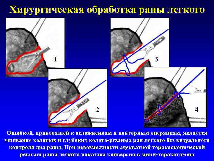 Хирургическая обработка раны легкого 1 3 2 4 Ошибкой, приводящей к осложнениям и повторным