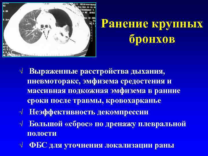 Ранение крупных бронхов √ √ Выраженные расстройства дыхания, пневмоторакс, эмфизема средостения и массивная подкожная