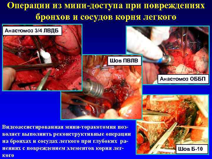 Операции из мини-доступа при повреждениях бронхов и сосудов корня легкого Анастомоз 3/4 ЛВДБ Шов