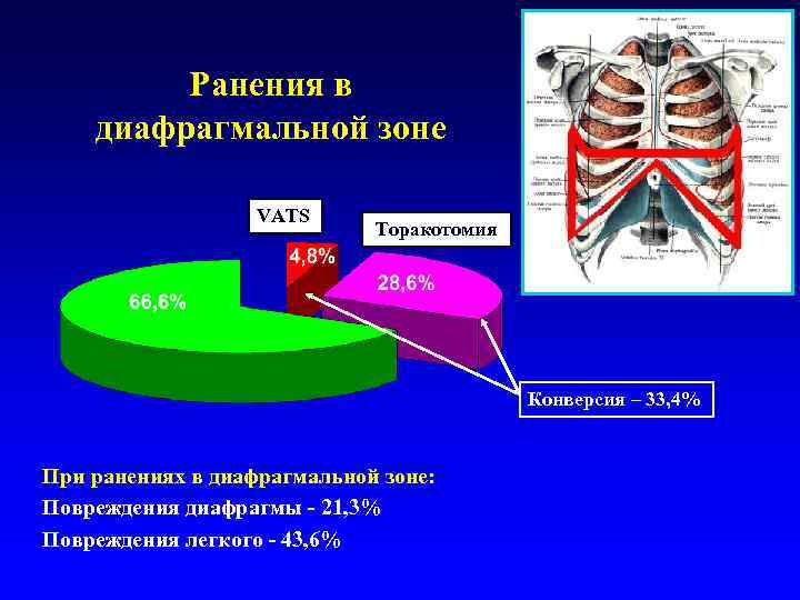 Ранения в диафрагмальной зоне VATS Торакотомия Конверсия – 33, 4% При ранениях в диафрагмальной