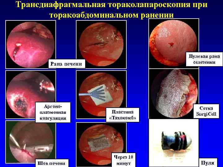 Трансдиафрагмальная тораколапароскопия при торакоабдоминальном ранении Пулевая рана селезенки Рана печени Аргоноплазменная коагуляция Шов печени