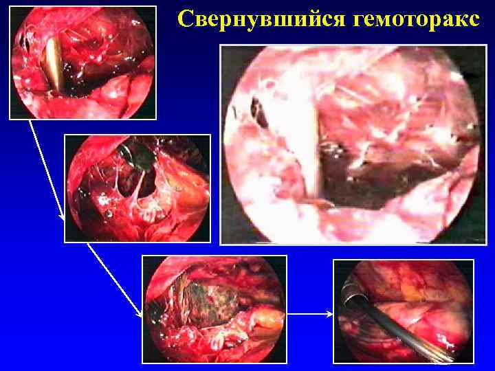 Свернувшийся гемоторакс 