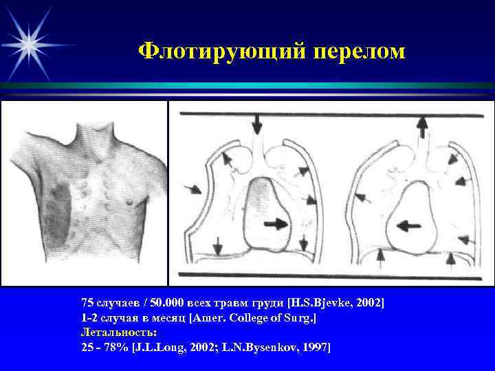 Флотирующий перелом 75 случаев / 50. 000 всех травм груди [H. S. Bjevke, 2002]