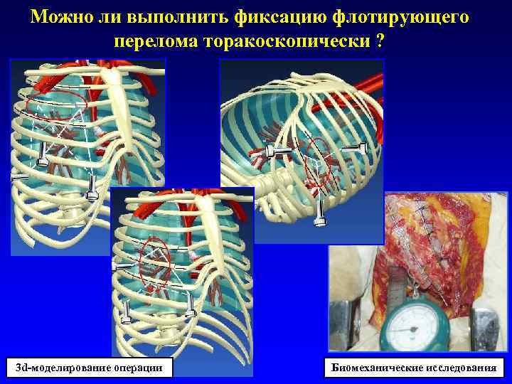 Можно ли выполнить фиксацию флотирующего перелома торакоскопически ? 3 d-моделирование операции Биомеханические исследования 