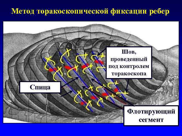 Метод торакоскопической фиксации ребер Шов, проведенный под контролем торакоскопа Спица Флотирующий сегмент 