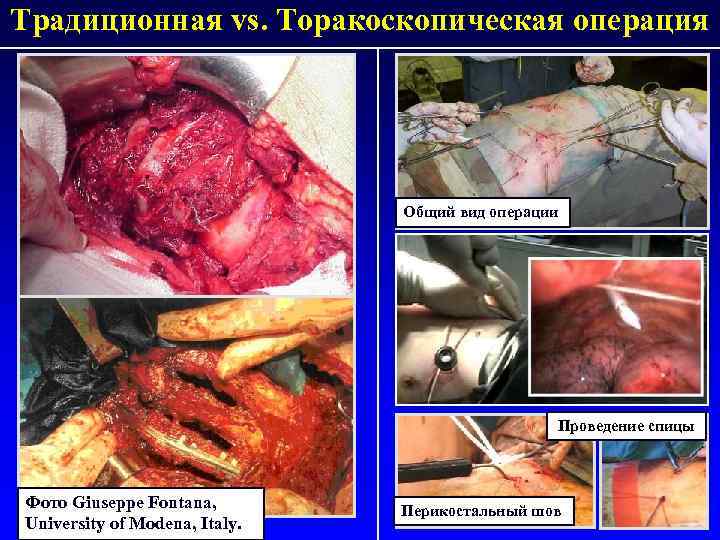 Традиционная vs. Торакоскопическая операция Общий вид операции Проведение спицы Фото Giuseppe Fontana, University of