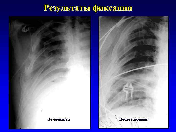 Результаты фиксации До операции После операции 