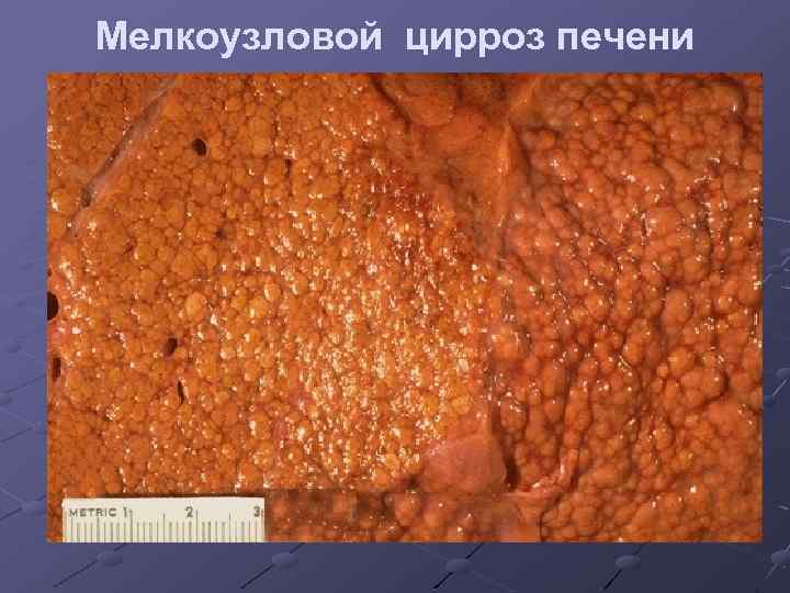 Мелкоузловой цирроз печени 