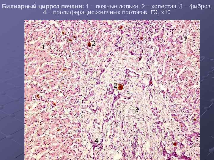 Билиарный цирроз печени: 1 – ложные дольки, 2 – холестаз, 3 – фиброз, 4