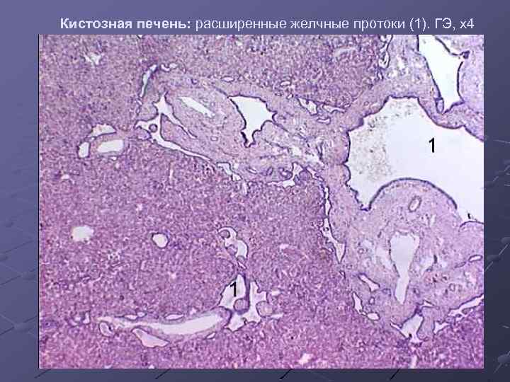 Кистозная печень: расширенные желчные протоки (1). ГЭ, х4 