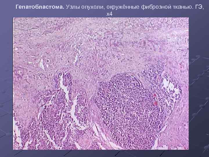 Гепатобластома. Узлы опухоли, окружённые фиброзной тканью. ГЭ, х4 