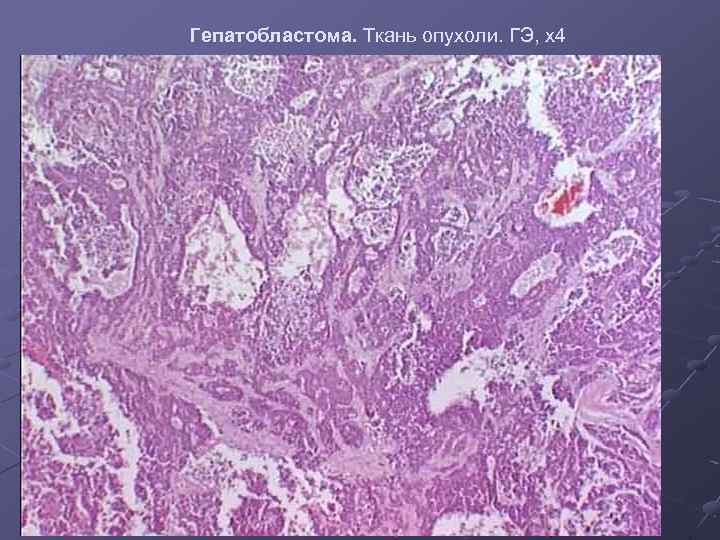 Гепатобластома. Ткань опухоли. ГЭ, х4 