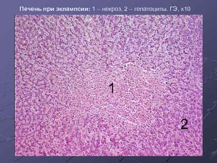 Трубная беременность микропрепарат. Печень при эклампсии микропрепарат. Рисунок микропрепарата печень при эклампсия.