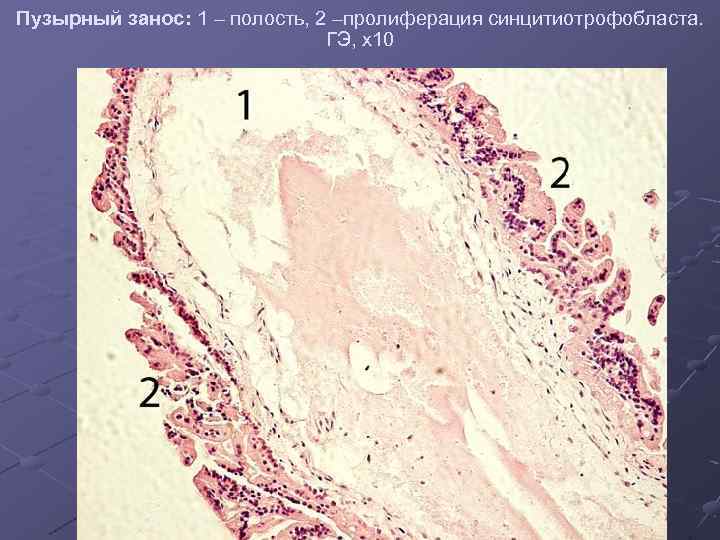 Трубная беременность микропрепарат рисунок