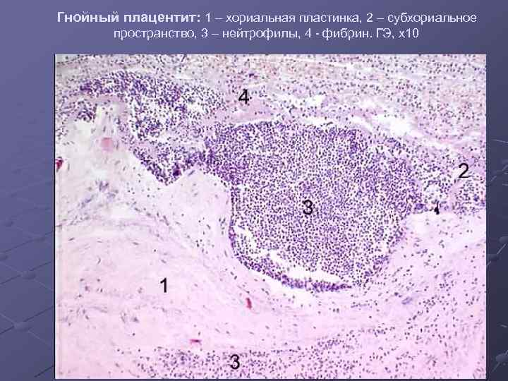 Трубная беременность микропрепарат. Плацентит микропрепарат описание. Гнойный плацентит микропрепарат. Базальный децидуит гистология.